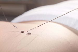 You Try Acupuncture for Anxiety