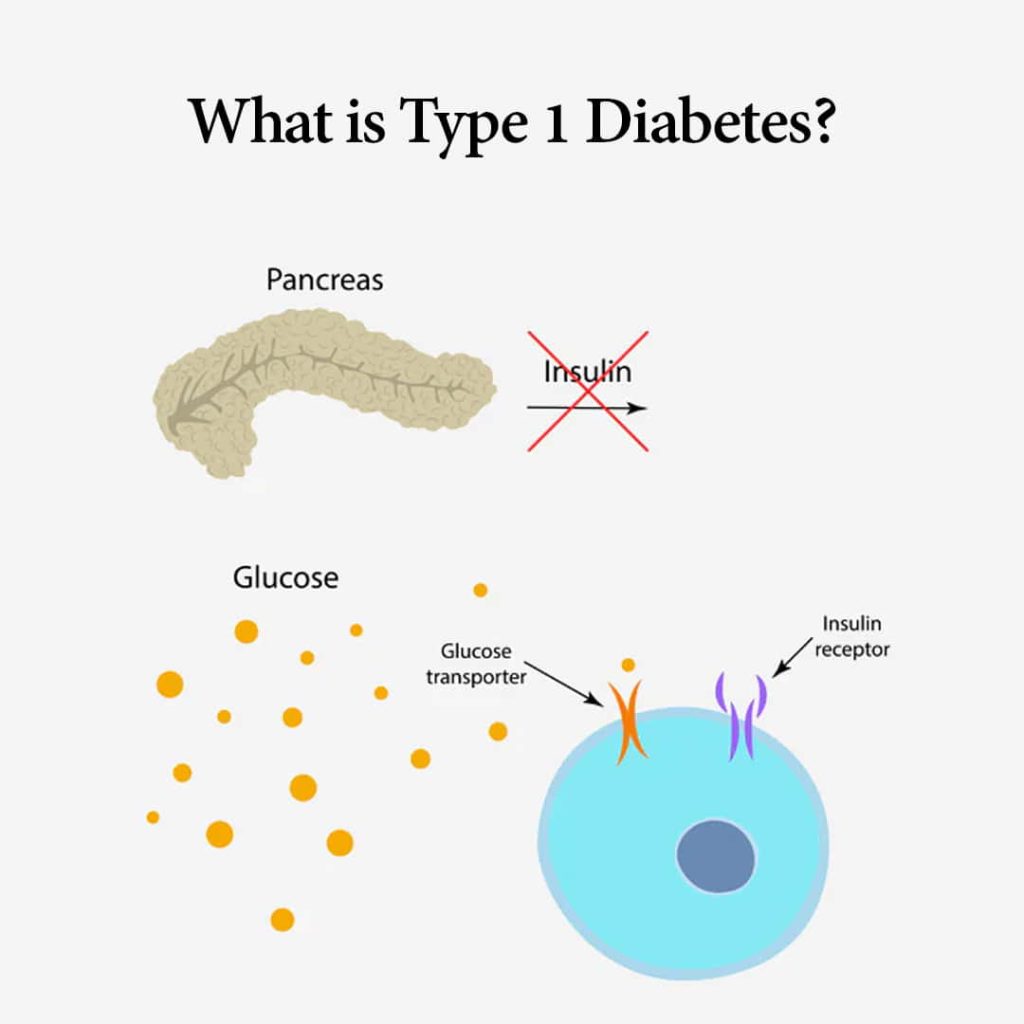 Type 1 Diabetes